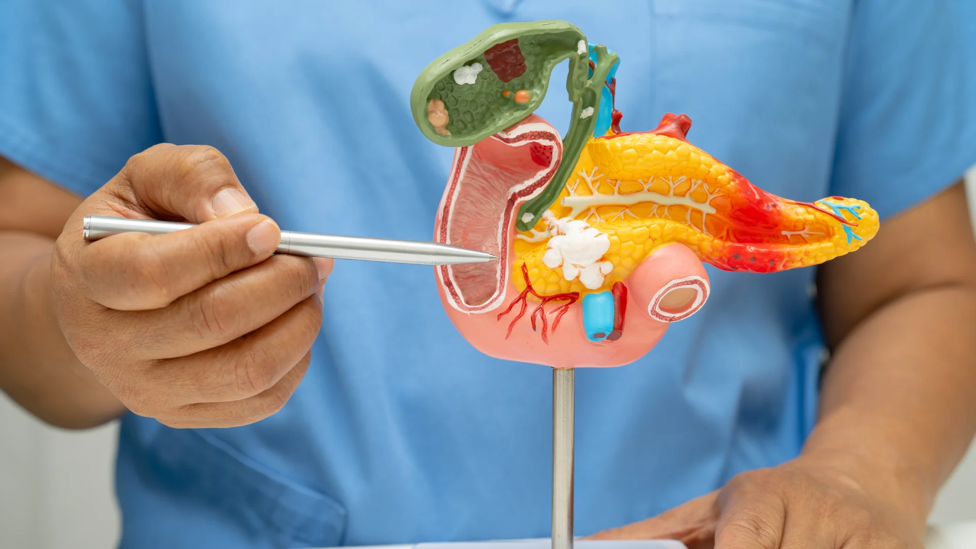 Chronic Pancreatitis